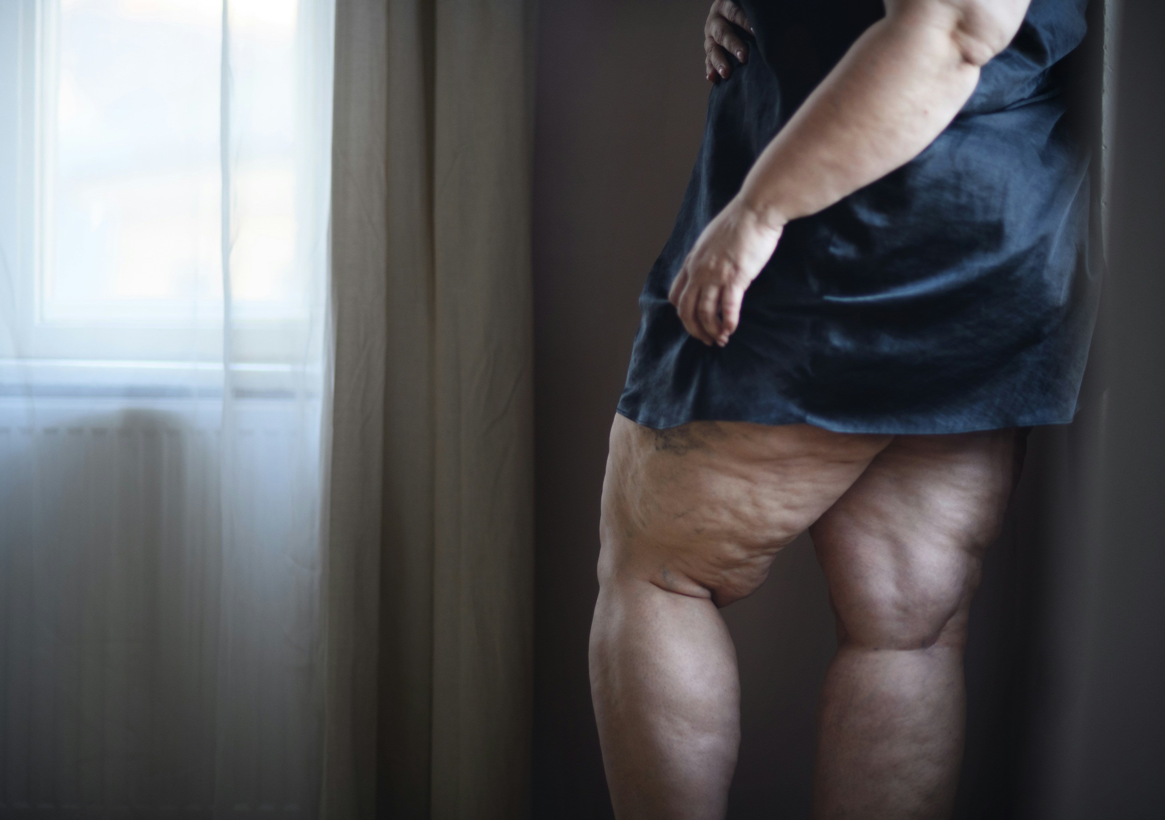 Ritenzione idrica e tiroide: cause, sintomi e consigli utili